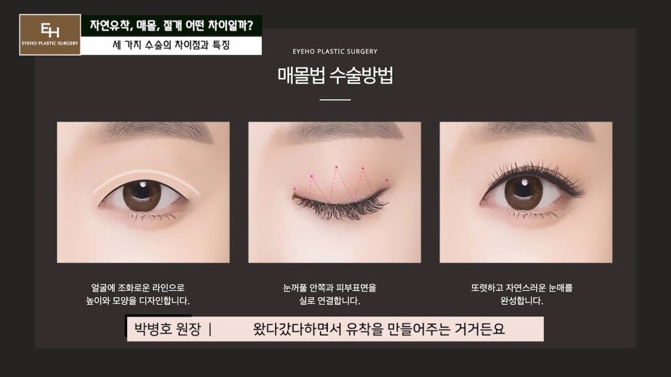 쌍수 자연유착 매몰 절개 차이점과 선택 기준 알려드릴게요. 관련 이미지 6