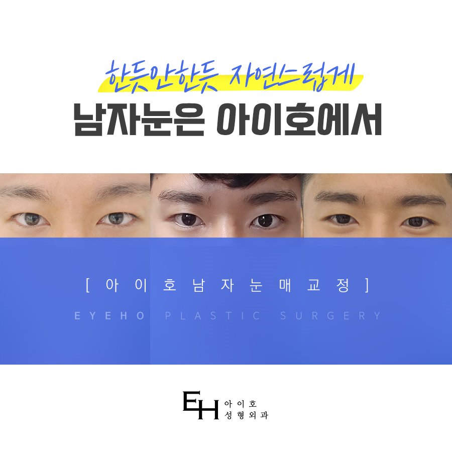 남자 눈매교정 가격 및 남자 눈매교정 전후 차이 비교 분석 관련 이미지 6