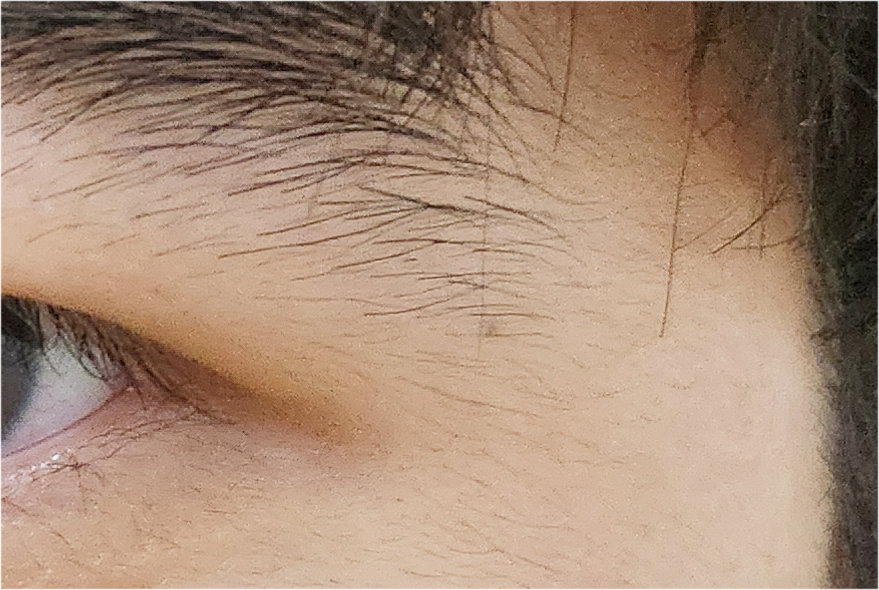 Effectively Achieving a Natural Look with Male Eye Surgery image 20