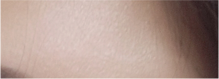 If You’re Considering Non-Incisional Eye Correction Surgery, Compare Reviews image 19