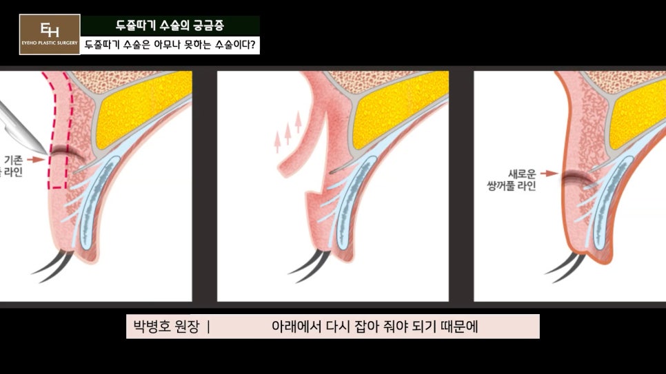 더 이상 물러설 때가 없는 재수술 두줄따기 궁금해요! 관련 이미지 14