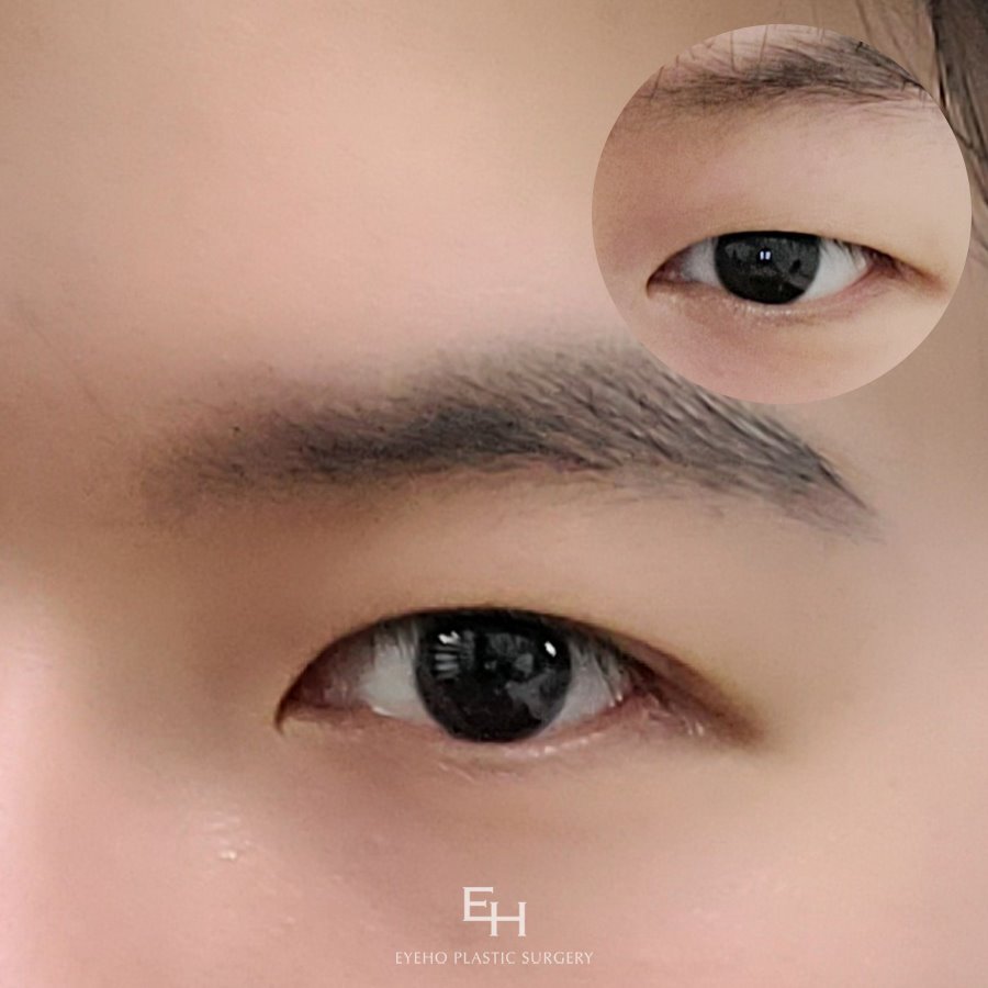 Male Double Eyelid Surgery Price: Comparing Carefully image 1