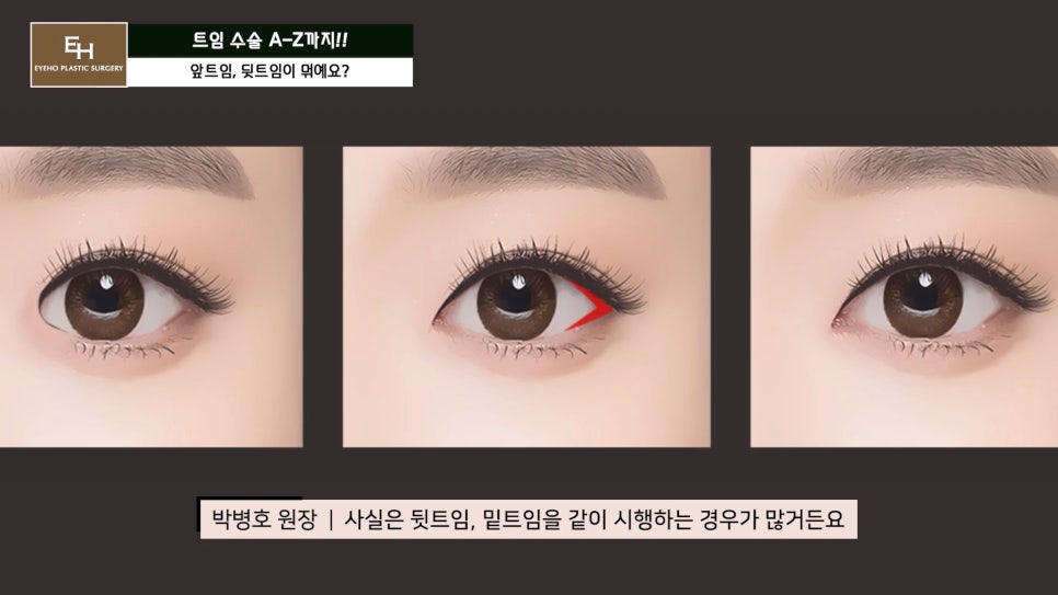 Everything About Canthoplasty, Explained by IHO image 15