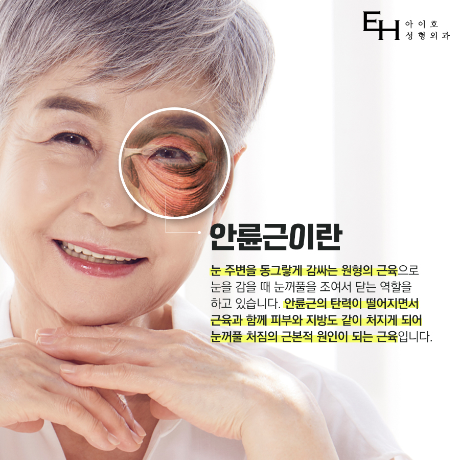 상안검수술가격 부작용 없이 회복기간 위하여 관련 이미지 3