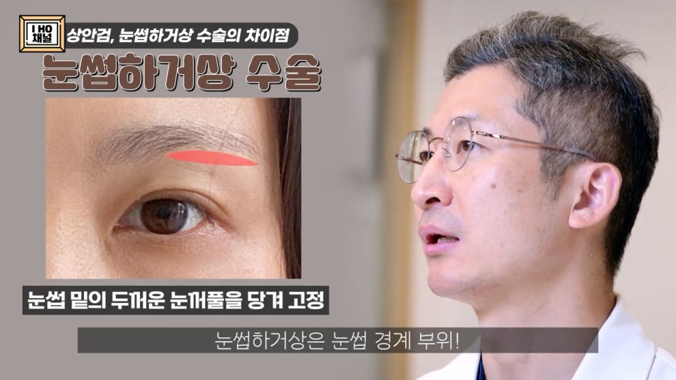 Which Is the Right Surgery for Me for Sagging Eyelids: Upper Blepharoplasty or Brow Lift? image 3