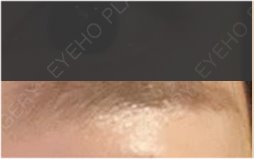Changed Appearance Before and After Eye Revision Surgery image 35