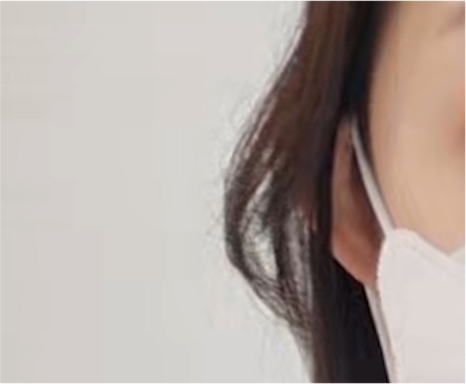 Double Eyelid Revision Surgery Review: You Must Be Careful with Extremely Difficult Eyes image 20