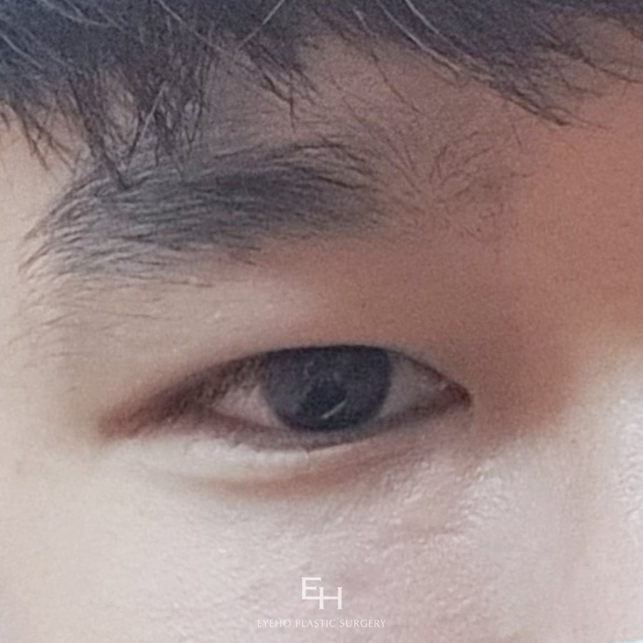 남자눈매교정비용 알아보고 계신다면 관련 이미지 1