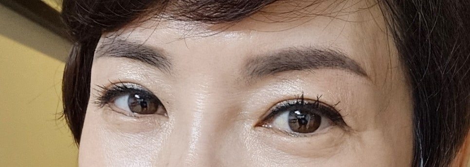 Upper Blepharoplasty for Drooping Eyes: Cost and Recovery Period image 15