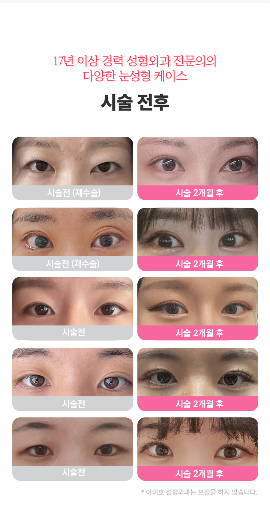 쌍꺼풀수술 가격 & 비절개 눈매교정 후기 (7일 경과) / 짝눈쌍수 관련 이미지 7