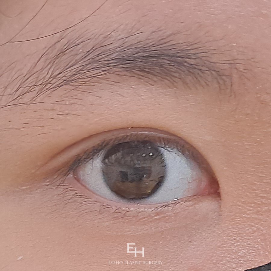 Double Eyelid Surgery Review After 7 Days: Double Eyelid Surgery Cost and Price Comparison Analysis image 14