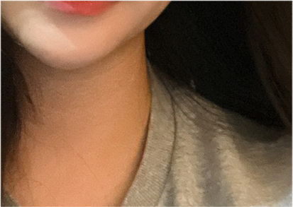 Comparing Incisional and Non-incisional Double Eyelid Surgery Before and After image 23