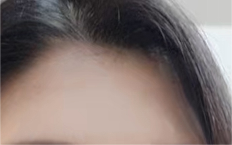 Double Eyelid Revision Surgery Review: You Must Be Careful with Extremely Difficult Eyes image 18