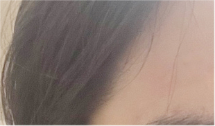 남자절개눈매교정 N일차 경과 : 남자 눈매교정 가격 / 무쌍눈매교정 전후 후기 사례 관련 이미지 19