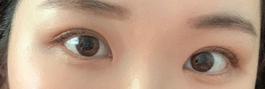 Natural Eye Line Before and After Double Eyelid Incision Surgery image 1