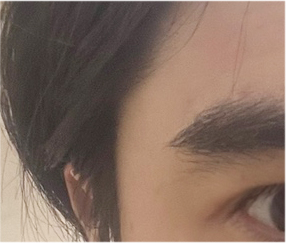 남자 눈매교정 가격 및 남자 눈매교정 전후 차이 비교 분석 관련 이미지 20