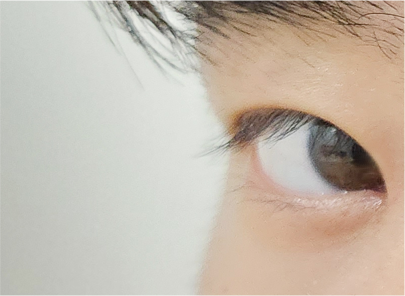 Effectively Achieving a Natural Look with Male Eye Surgery image 18