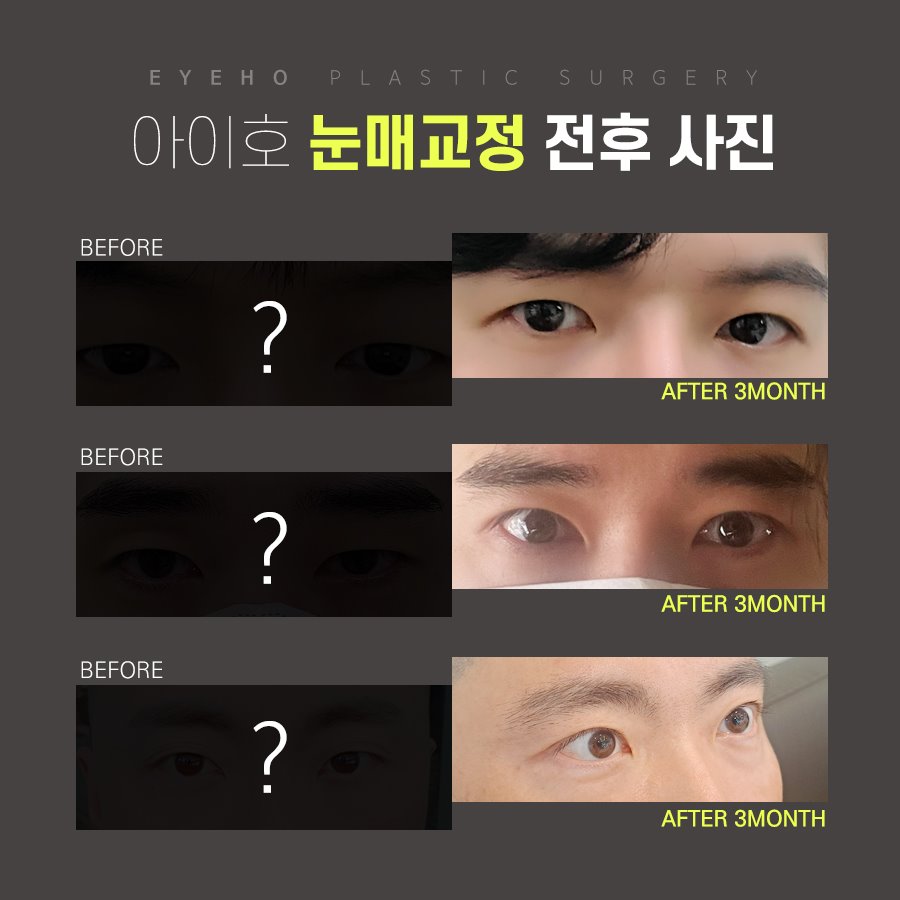 남자눈매교정가격 세심하게 따져봐야 관련 이미지 5