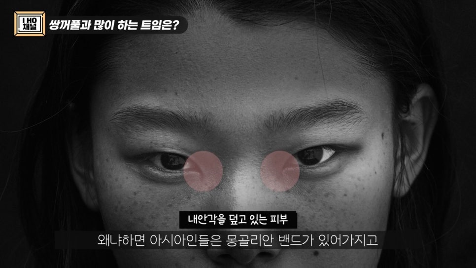 Do Double Eyelid Surgery and Canthoplasty Have to Be Done Together? image 11