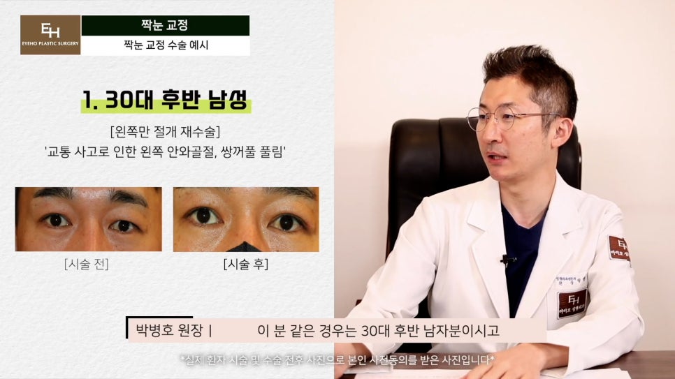 짝눈이 고민인데 양쪽 눈 수술하기 싫어요!! 한쪽 눈만 수술 가능!? 관련 이미지 9