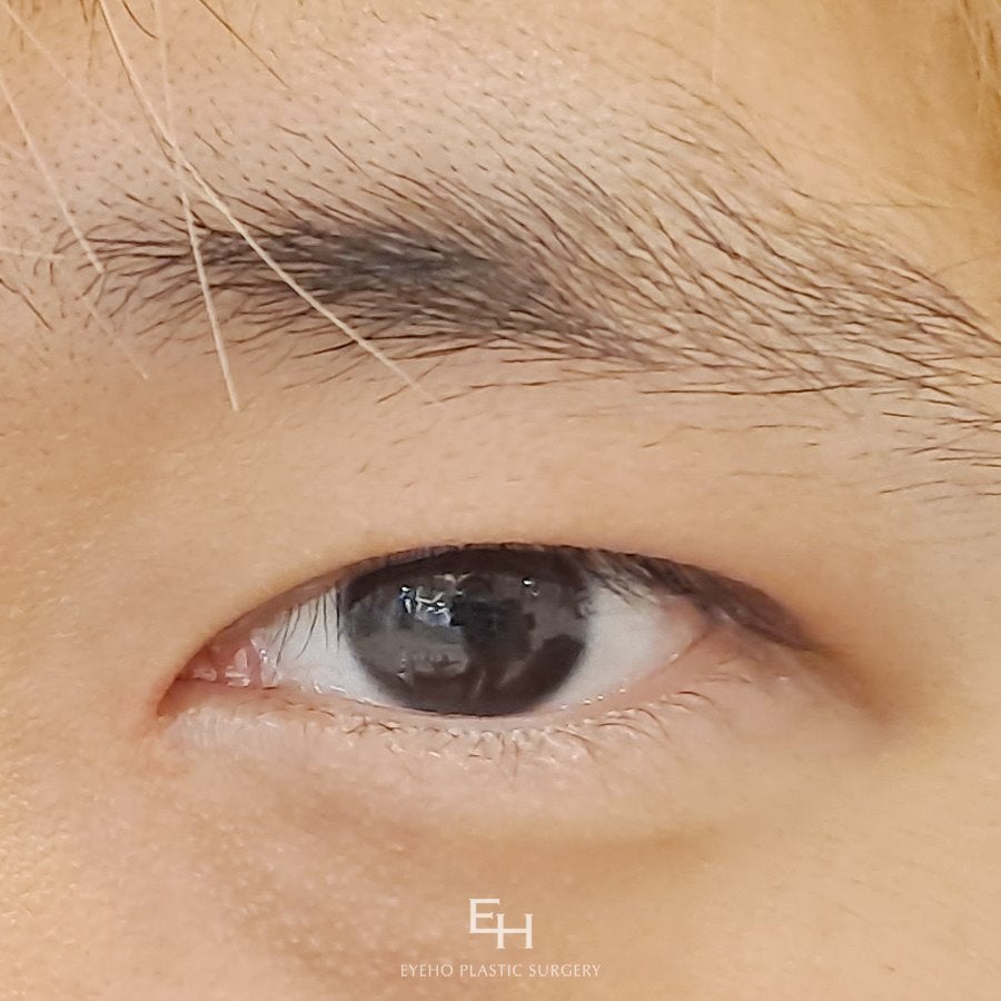 Before and After Male Eye Correction: Incisional Eyelid Correction Cost_ Monolid Ptosis Surgery Review (Day 1 to Day 7 Progress) image 14