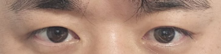 For a Natural Eye Shape Before and After Male Eye Surgery image 17