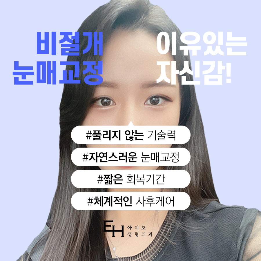 쌍수 매몰법 자연스러운 눈매로 관련 이미지 3