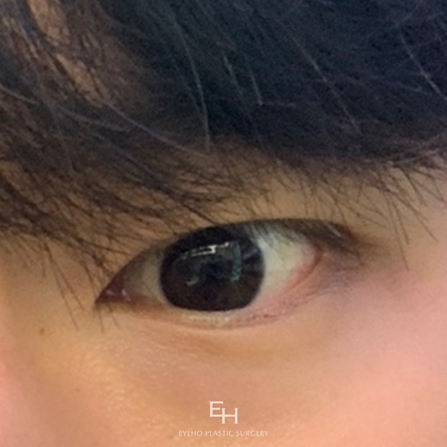 I Hope This Double Eyelid Incision Revision Surgery Is the Last One image 15