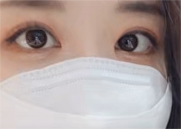 Double Eyelid Revision Surgery Review: You Must Be Careful with Extremely Difficult Eyes image 21