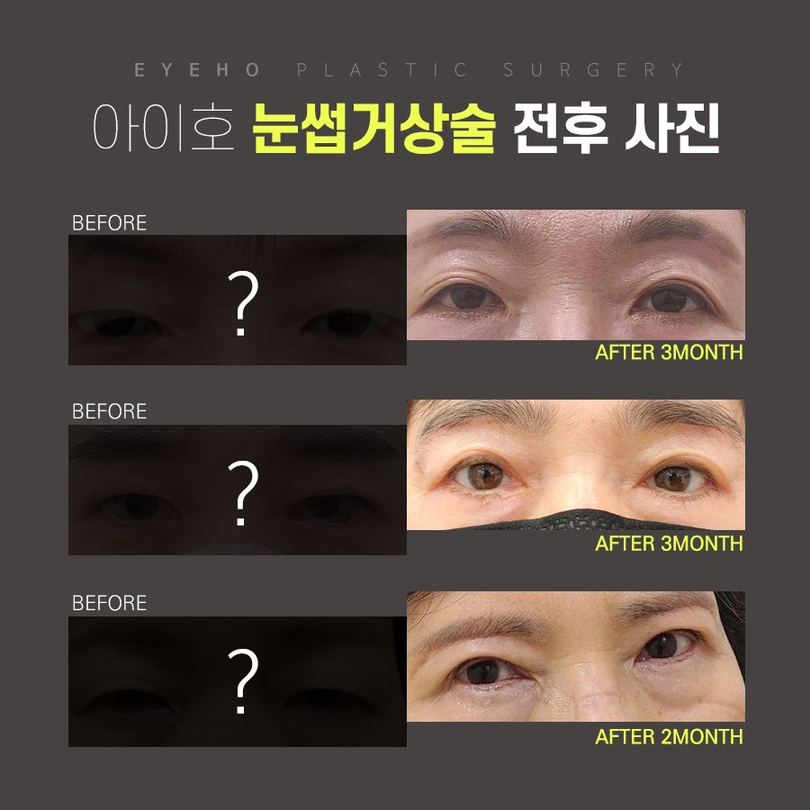Brow Lift Cost and Brow Lift Review, Pain, and Precautions image 5