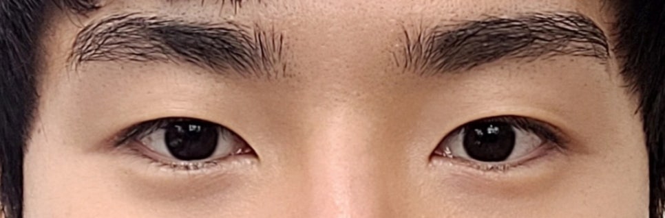 남자눈성형 자연스러운 눈매 후기 관련 이미지 14