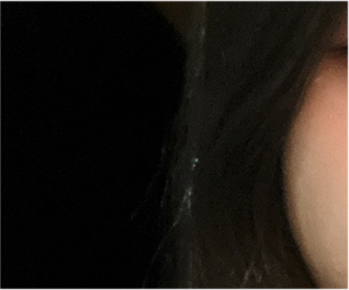 Comparing Incisional and Non-incisional Double Eyelid Surgery Before and After image 19