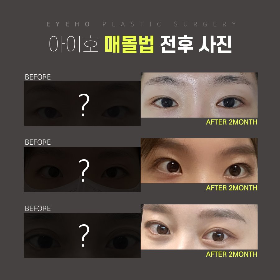 Double Eyelid Surgery with the Buried Suture Method: No Need to Worry About Swelling image 4