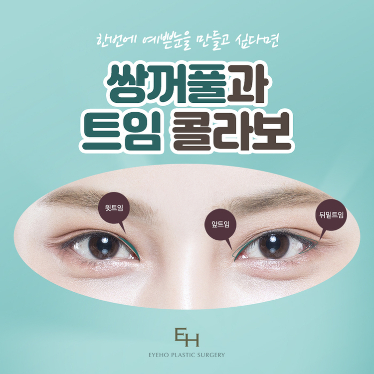 Natural and Harmonious Male Double-Eyelid Correction image 6
