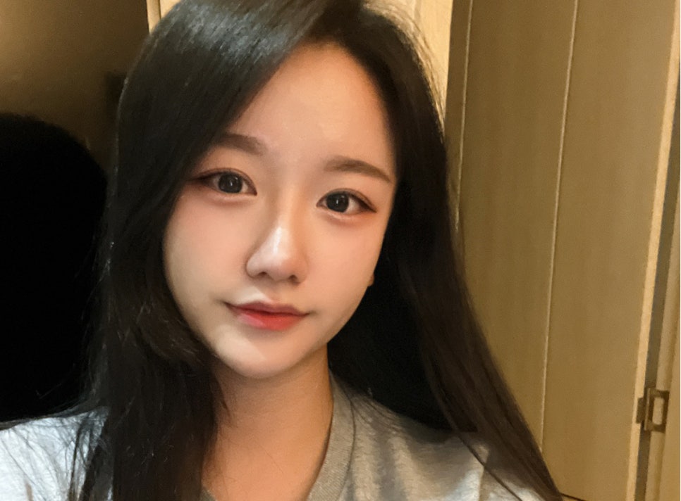 Comparing Incisional and Non-incisional Double Eyelid Surgery Before and After image 1