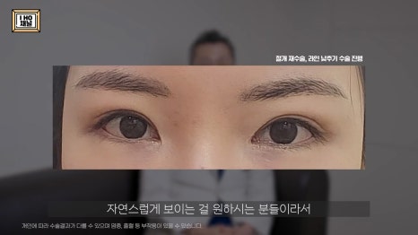 소세지눈 다 같은 게 아니다!? 유형별 재수술 방법에 대해 알려드리겠습니다. 관련 이미지 55
