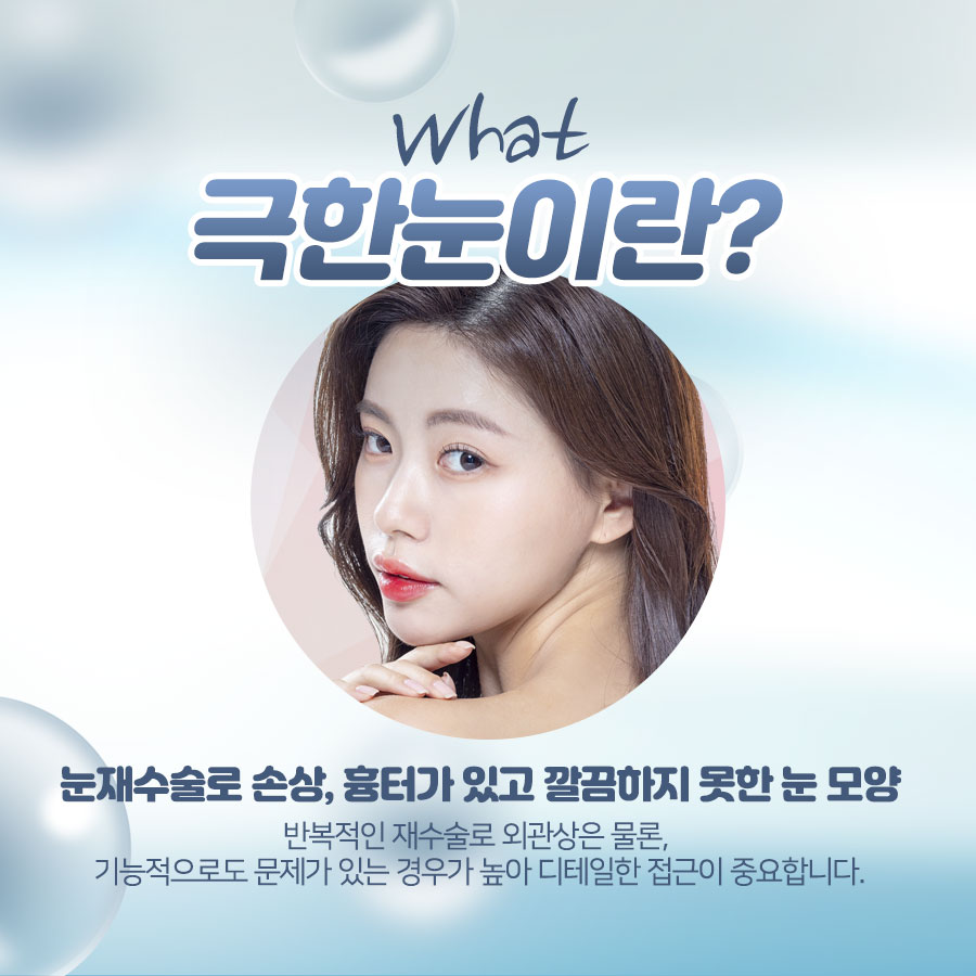 Double Eyelid Revision Surgery Review: You Must Be Careful with Extremely Difficult Eyes image 4