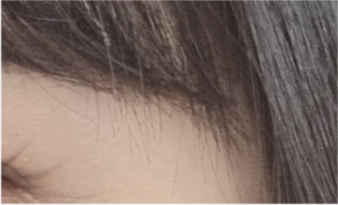 중년 상안검 수술 후기 : 눈처짐 상안검 수술 가격 & 붓기 N일차 경과 관련 이미지 18