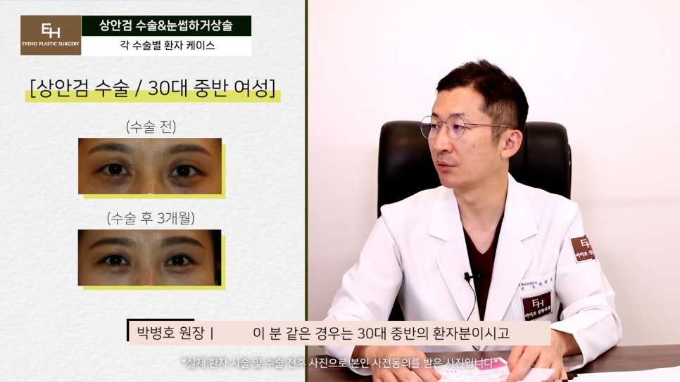 처진눈 상안검? 눈썹하거상술? 궁금하시다면 들어와!! 관련 이미지 28