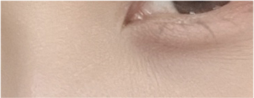 중년 상안검 수술 후기 : 눈처짐 상안검 수술 가격 & 붓기 N일차 경과 관련 이미지 20