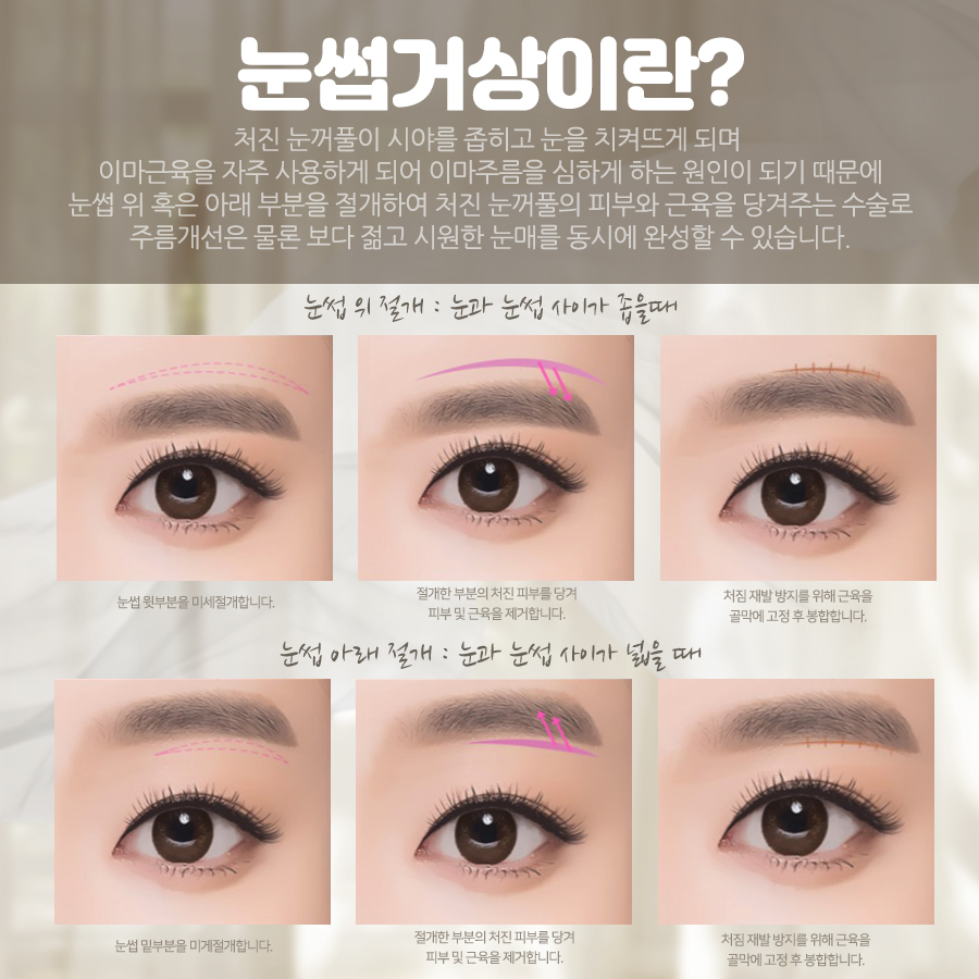 중년눈성형 종류 나에게 맞는 올바른 수술 방법 관련 이미지 5