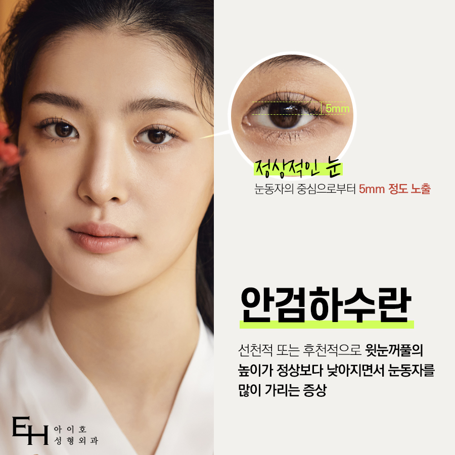 안검하수 눈매교정 졸린눈 고민 해결하자 관련 이미지 2