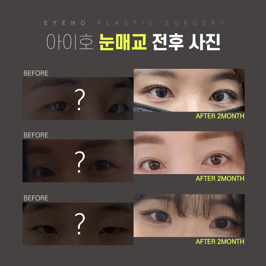 눈매교정술 또렷한 눈매나 관련 이미지 6
