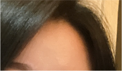 Comparing Incisional and Non-incisional Double Eyelid Surgery Before and After image 17