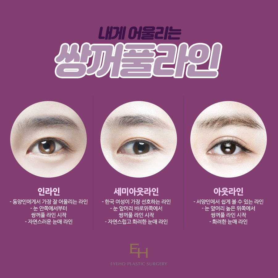 쌍수 매몰법 눈성형잘하는병원 후기 신중히 살핀다면 관련 이미지 3