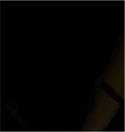 눈매교정 안검하수수술 비용 그리고 무쌍눈매교정후기 N일차 관련 이미지 17