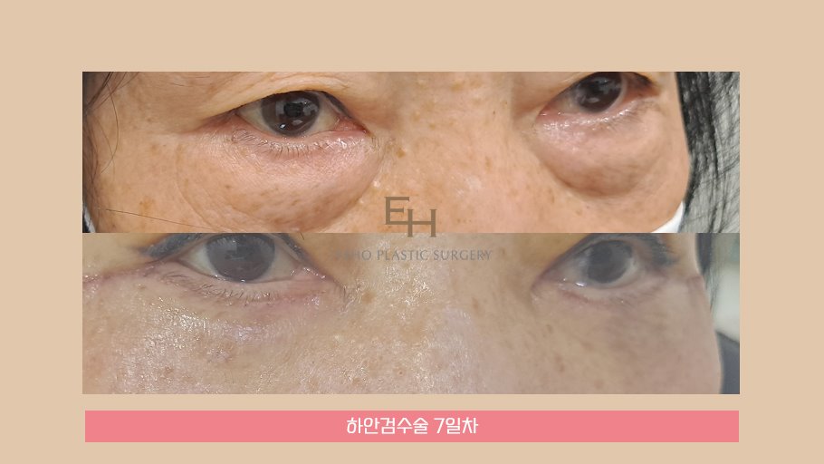 하안검 수술 후기 / 눈밑처짐수술 회복기간 관련 이미지 5