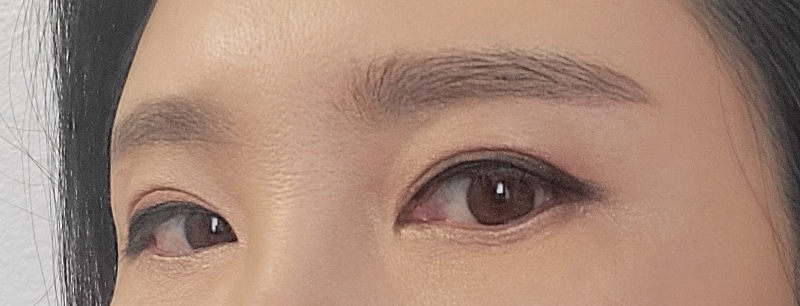 Brow Lift Cost and Brow Lift Review, Pain, and Precautions image 18