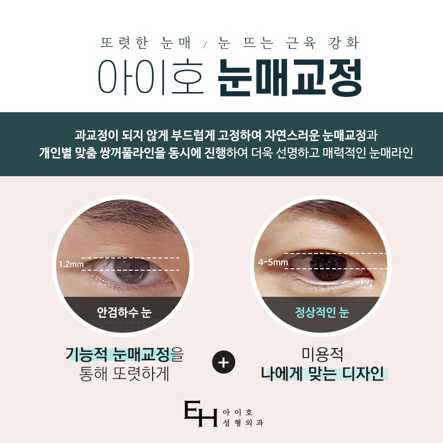 남자눈매교정전후 세세하게 파악해보면서 관련 이미지 3