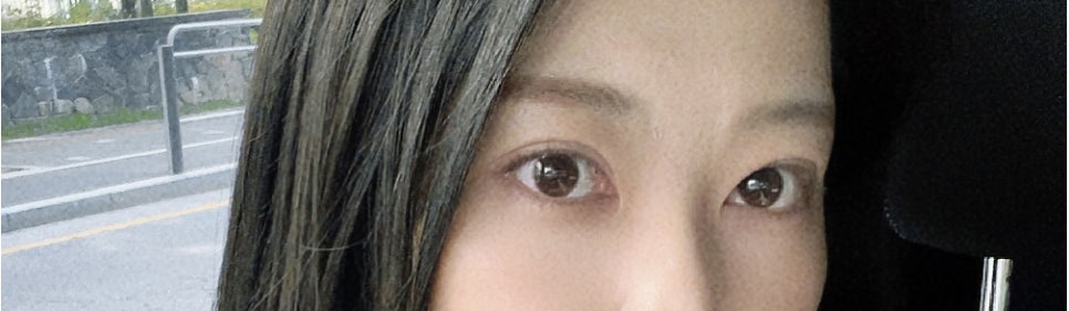 쌍수 눈재수술 비용 및 한쪽 재수술 / 짝눈 재수술 방법 공유 관련 이미지 19